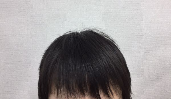 【薄毛速報】厚生労働省が発毛効果を認めた育毛剤が生えすぎて凄い…試してみた結果は？