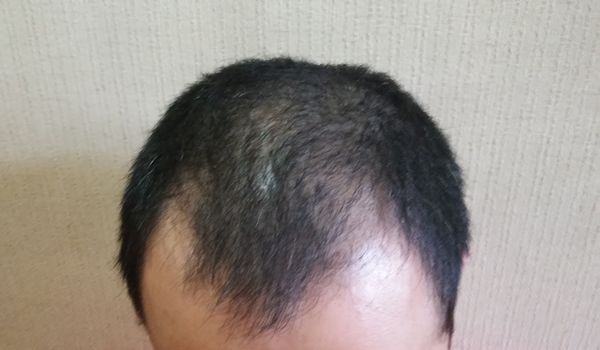 地球からハゲがいなくなる！？●●するだけで生える育毛剤が本当に凄かった！試してみた結果は？